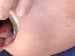 Close up from my extreme anal gape and prolapse