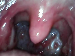 Braced girl's uvula endoscope